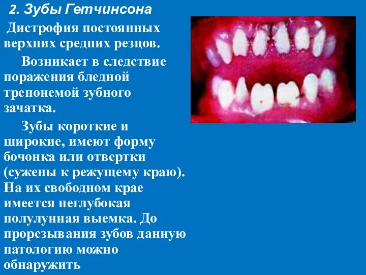 2. Зубы Гетчинсона Дистрофия постоянных верхних средних резцов. Возникает в