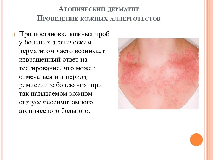 Атопический дерматит Проведение кожных аллерготестов При постановке кожных проб у