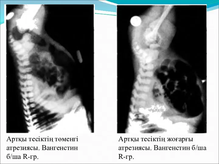 Артқы тесіктің төменгі атрезиясы. Вангенстин б/ша R-гр. Артқы тесіктің жоғарғы атрезиясы. Вангенстин б/ша R-гр.