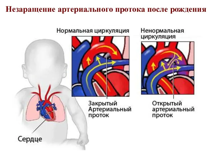 Незаращение артериального протока после рождения