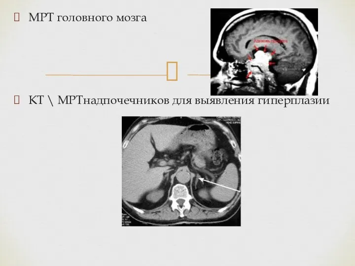 МРТ головного мозга КТ \ МРТнадпочечников для выявления гиперплазии