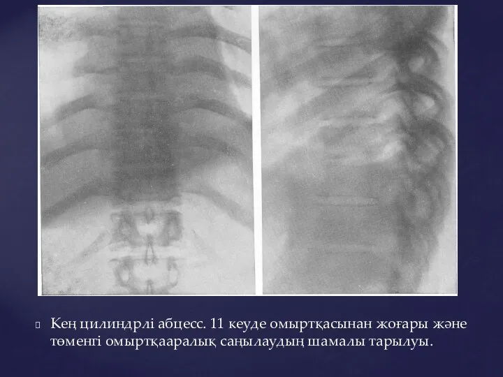 Кең цилиндрлі абцесс. 11 кеуде омыртқасынан жоғары және төменгі омыртқааралық саңылаудың шамалы тарылуы.