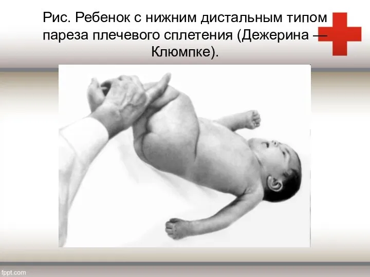 Рис. Ребенок с нижним дистальным типом пареза плечевого сплетения (Дежерина — Клюмпке).