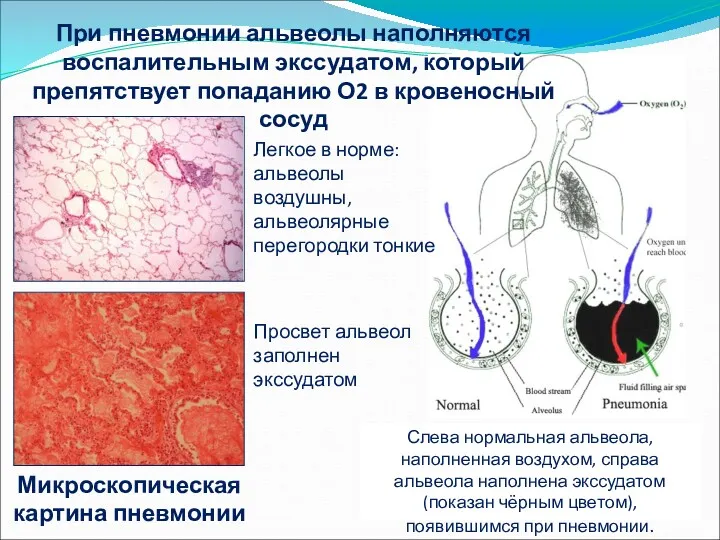 При пневмонии альвеолы наполняются воспалительным экссудатом, который препятствует попаданию О2