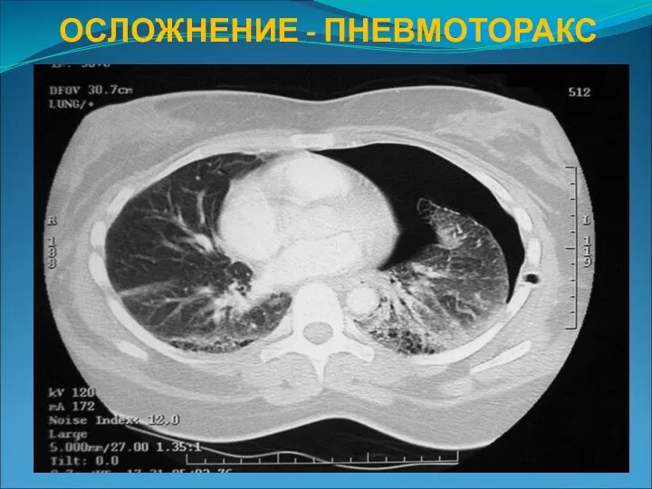 ОСЛОЖНЕНИЕ - ПНЕВМОТОРАКС