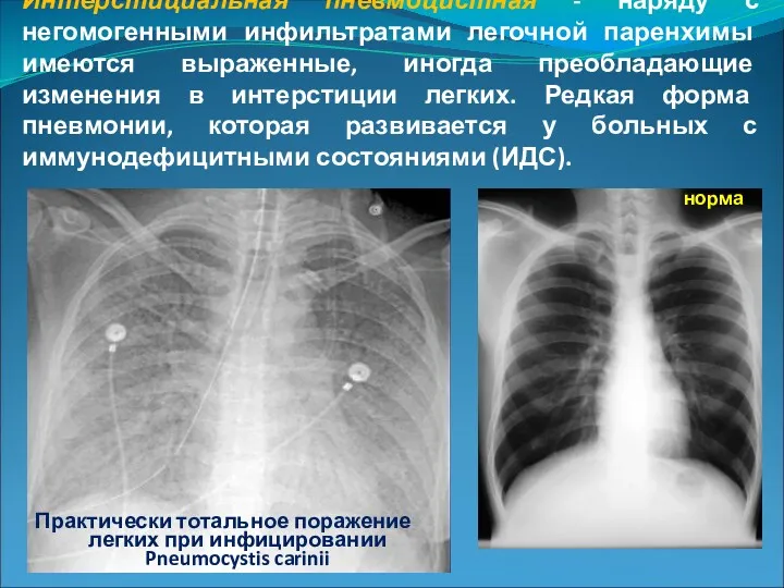 Интерстициальная пневмоцистная - наряду с негомогенными инфильтратами легочной паренхимы имеются