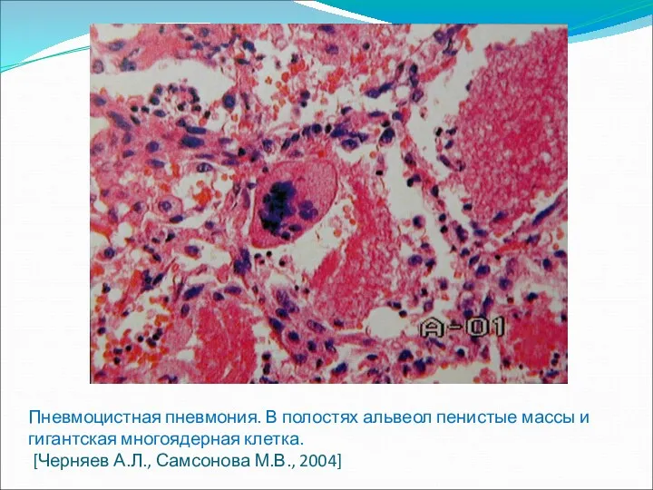 Пневмоцистная пневмония. В полостях альвеол пенистые массы и гигантская многоядерная клетка. [Черняев А.Л., Самсонова М.В., 2004]