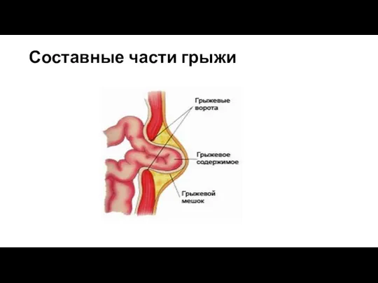 Составные части грыжи