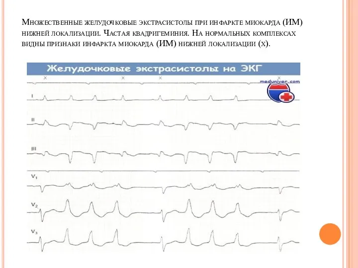 Множественные желудочковые экстрасистолы при инфаркте миокарда (ИМ) нижней локализации. Частая