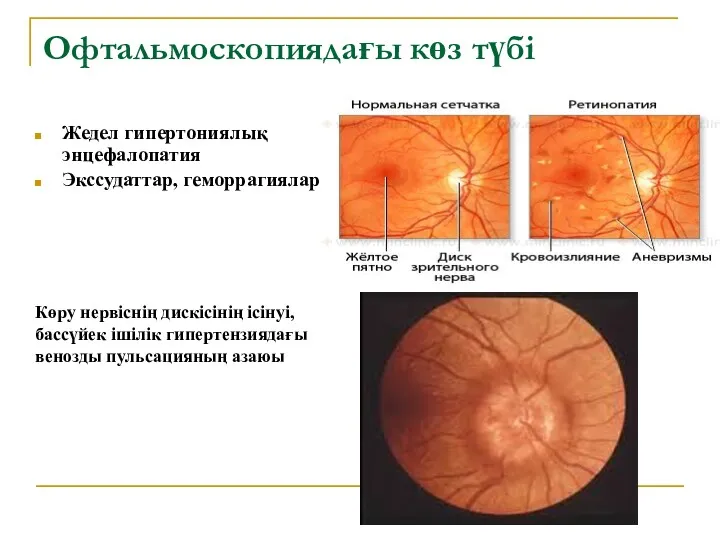 Офтальмоскопиядағы көз түбі Жедел гипертониялық энцефалопатия Экссудаттар, геморрагиялар Көру нервіснің