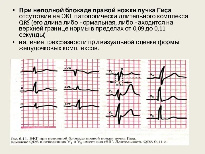 При неполной блокаде правой ножки пучка Гиса отсутствие на ЭКГ