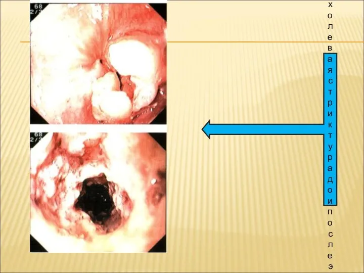 Рак пищевода: стенотическая опухолевая стриктура до и после эндоскопической реканализации