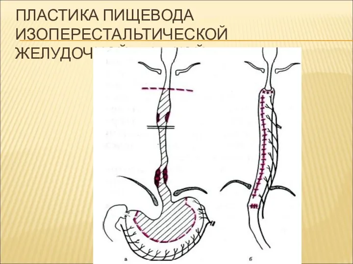 ПЛАСТИКА ПИЩЕВОДА ИЗОПЕРЕСТАЛЬТИЧЕСКОЙ ЖЕЛУДОЧНОЙ ТРУБКОЙ