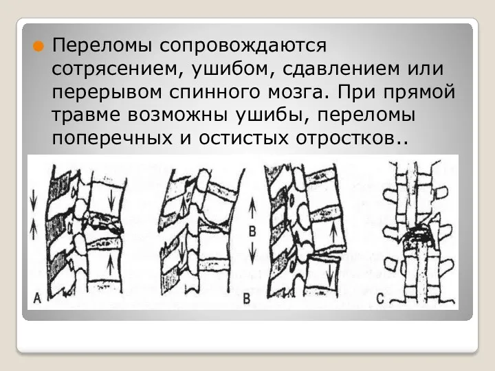 Переломы сопровождаются сотрясением, ушибом, сдавлением или перерывом спинного мозга. При прямой травме возможны