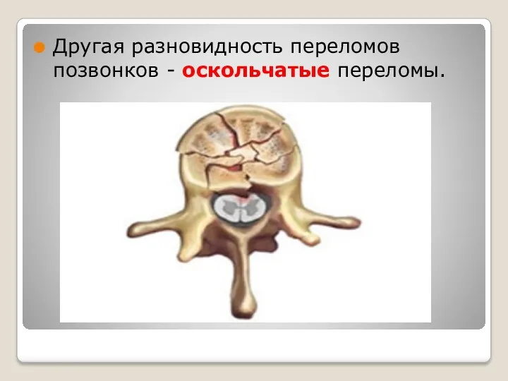 Другая разновидность переломов позвонков - оскольчатые переломы.