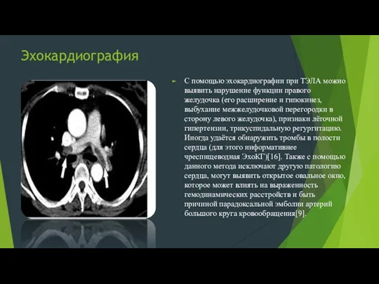 Эхокардиография С помощью эхокардиографии при ТЭЛА можно выявить нарушение функции