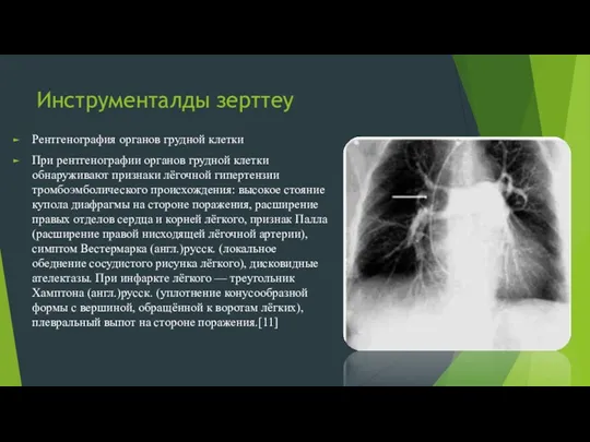 Инструменталды зерттеу Рентгенография органов грудной клетки При рентгенографии органов грудной