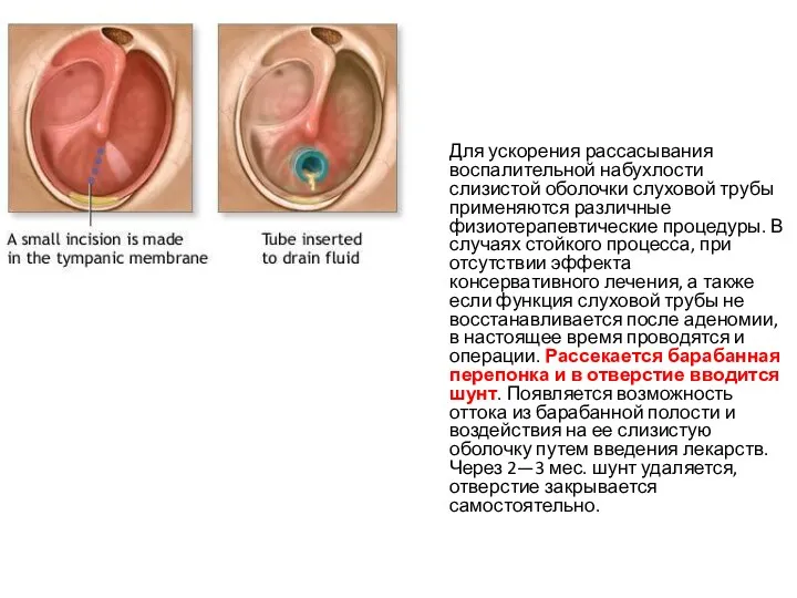 Для ускорения рассасывания воспалительной набухлости слизистой оболочки слуховой трубы применяются различные физиотерапевтические процедуры.