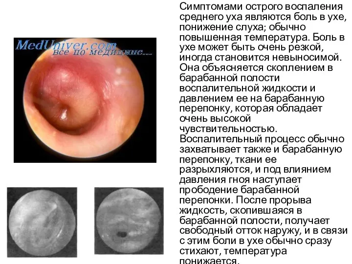 Симптомами острого воспаления среднего уха являются боль в ухе, понижение слуха; обычно повышенная