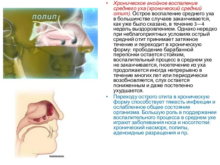 Хроническое гнойное воспаление среднего уха (хронический средний отит). Острое воспаление