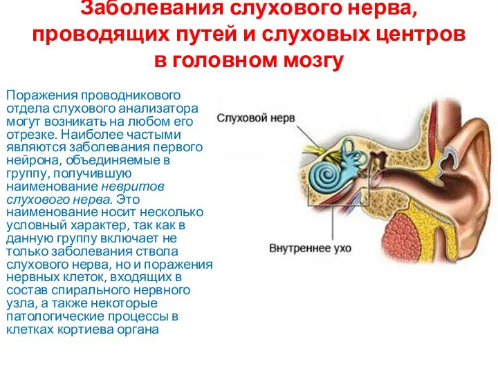 Заболевания слухового нерва, проводящих путей и слуховых центров в головном мозгу Поражения проводникового