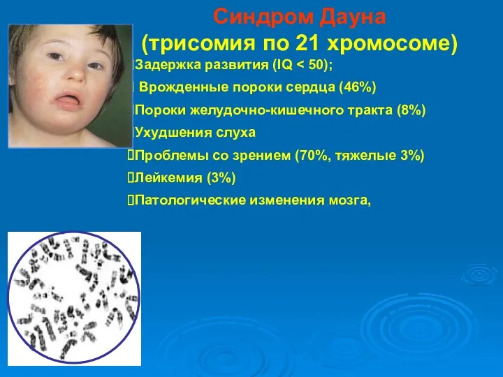 Синдром Дауна (трисомия по 21 хромосоме) Задержка развития (IQ Врожденные пороки сердца (46%)