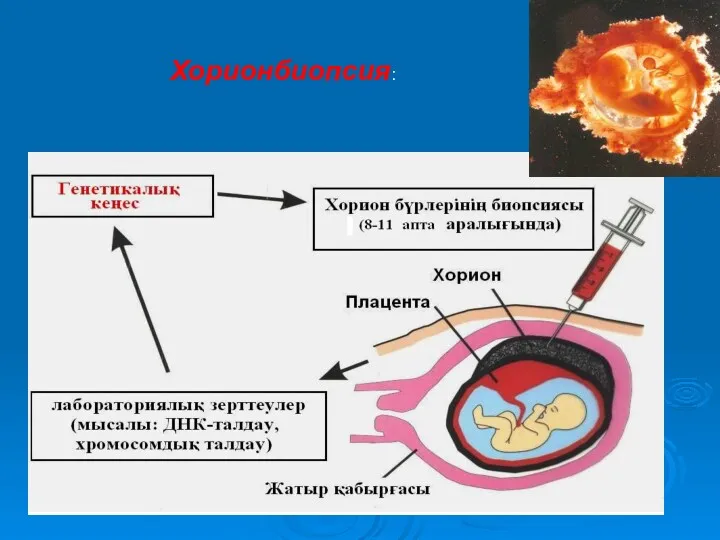 Хорионбиопсия: