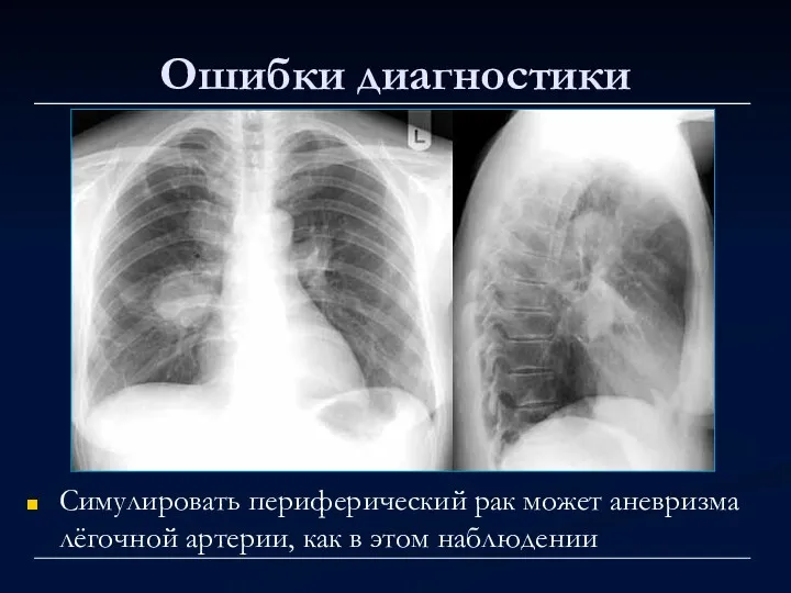 Ошибки диагностики Симулировать периферический рак может аневризма лёгочной артерии, как в этом наблюдении
