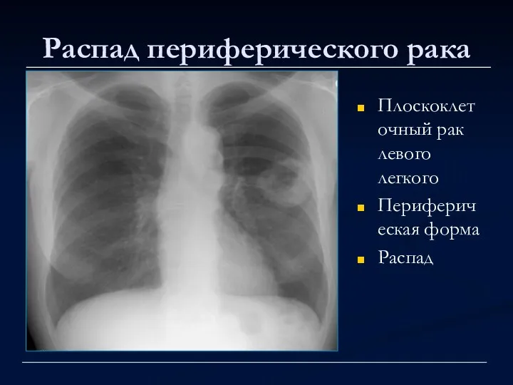 Распад периферического рака Плоскоклеточный рак левого легкого Периферическая форма Распад