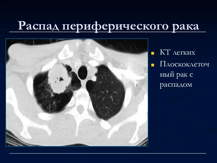 Распад периферического рака КТ легких Плоскоклеточный рак с распадом