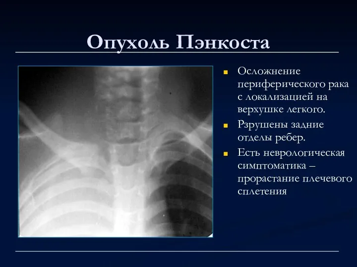 Опухоль Пэнкоста Осложнение периферического рака с локализацией на верхушке легкого.