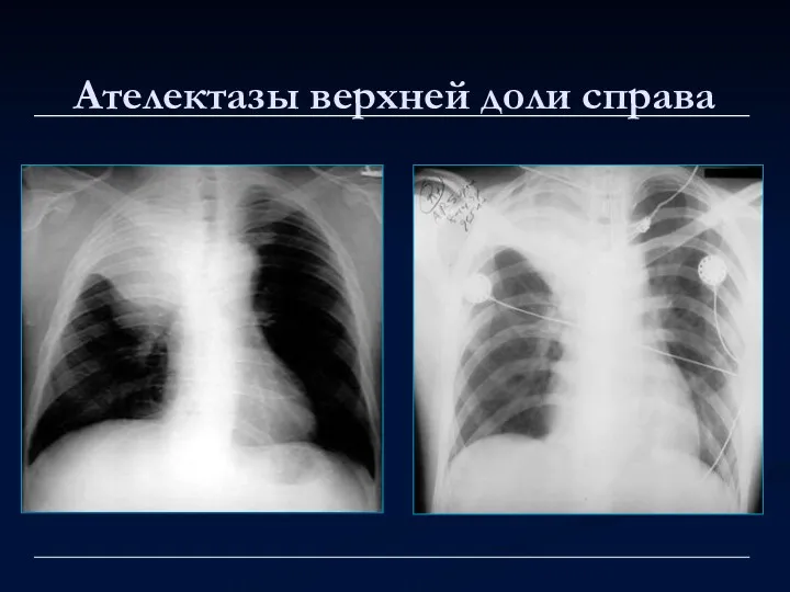 Ателектазы верхней доли справа