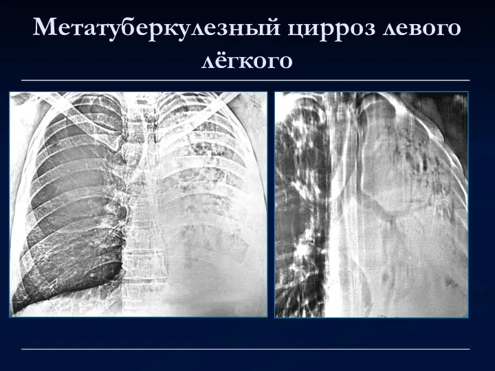 Метатуберкулезный цирроз левого лёгкого