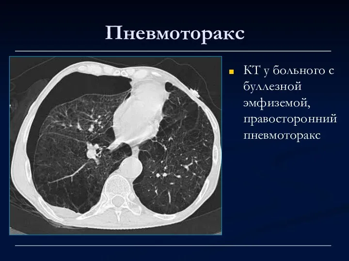Пневмоторакс КТ у больного с буллезной эмфиземой, правосторонний пневмоторакс