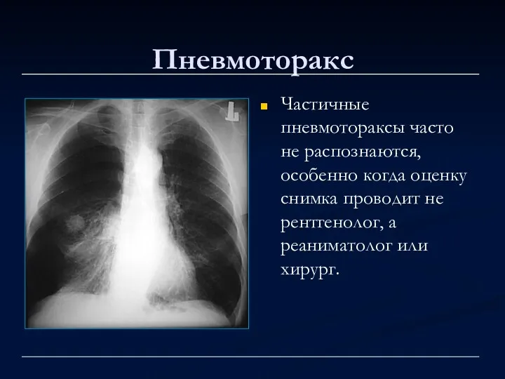 Пневмоторакс Частичные пневмотораксы часто не распознаются, особенно когда оценку снимка проводит не рентгенолог,