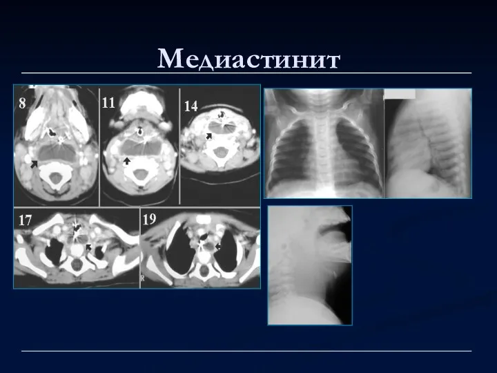 Медиастинит