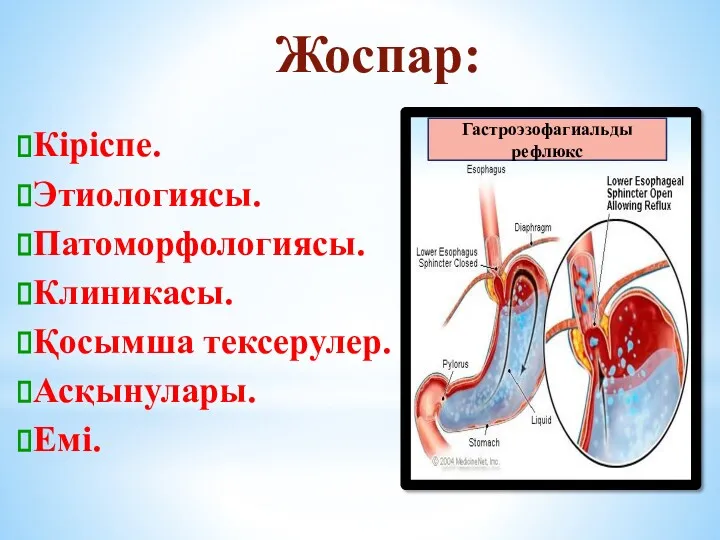 Жоспар: Кіріспе. Этиологиясы. Патоморфологиясы. Клиникасы. Қосымша тексерулер. Асқынулары. Емі. Гастроэзофагиальды рефлюкс