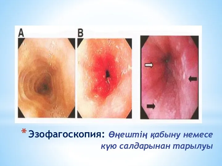 Эзофагоскопия: Өңештің қабыну немесе күю салдарынан тарылуы