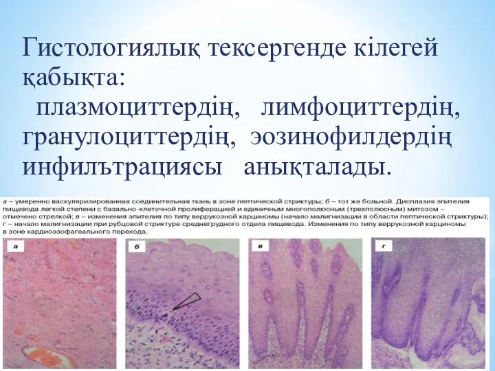 Гистологиялық тексергенде кілегей қабықта: плазмоциттердің, лимфоциттердің, гранулоциттердің, эозинофилдердің инфилътрациясы анықталады.