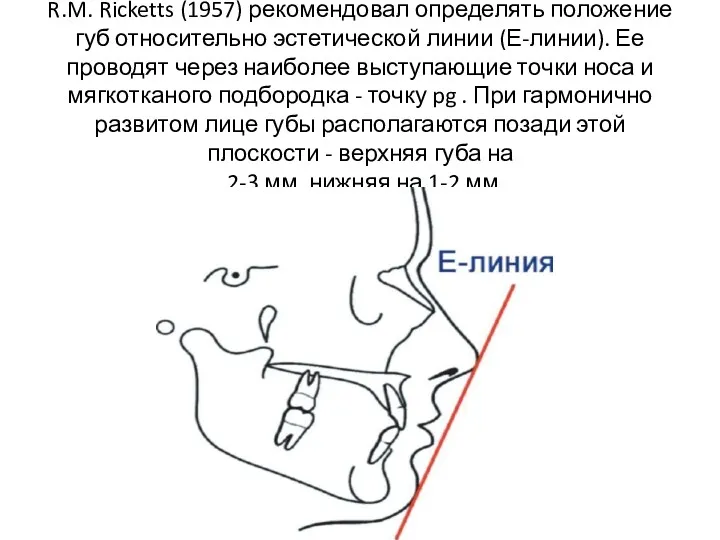 R.M. Ricketts (1957) рекомендовал определять положение губ относительно эстетической линии