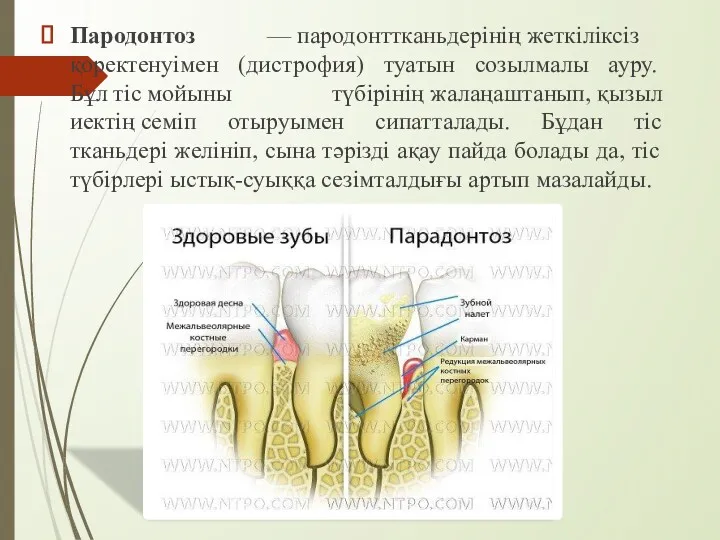 Пародонтоз — пародонттканьдерінің жеткіліксіз қоректенуімен (дистрофия) туатын созылмалы ауру. Бұл тіс мойыны түбірінің
