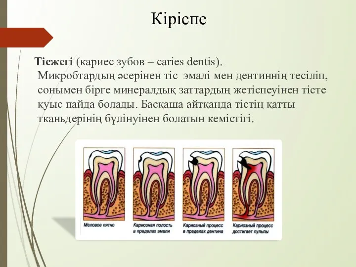 Кіріспе Тісжегі (кариес зубов – caries dentis). Микробтардың әсерінен тіс эмалі мен дентиннің