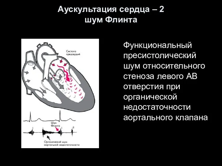 Аускультация сердца – 2 шум Флинта Функциональный пресистолический шум относительного стеноза левого АВ