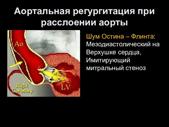 Аортальная регургитация при расслоении аорты Шум Остина – Флинта: Мезодиастолический на Верхушке сердца, Имитирующий митральный стеноз