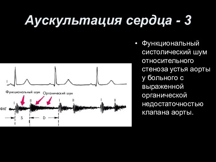 Аускультация сердца - 3 Функциональный систолический шум относительного стеноза устья аорты у больного