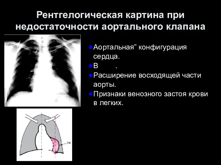 Рентгелогическая картина при недостаточности аортального клапана Аортальная” конфигурация сердца. В . Расширение восходящей