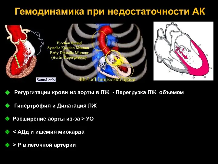 Гемодинамика при недостаточности АК Регургитации крови из аорты в ЛЖ