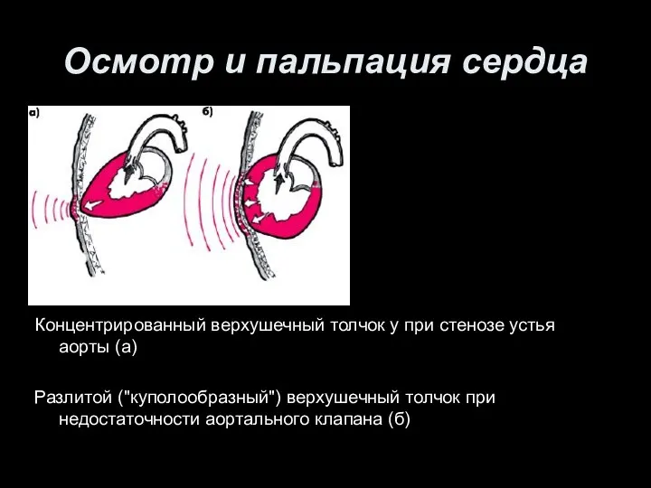 Осмотр и пальпация сердца Концентрированный верхушечный толчок у при стенозе