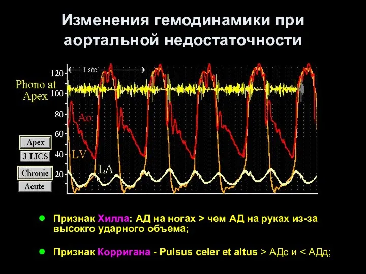 Изменения гемодинамики при аортальной недостаточности Признак Хилла: АД на ногах