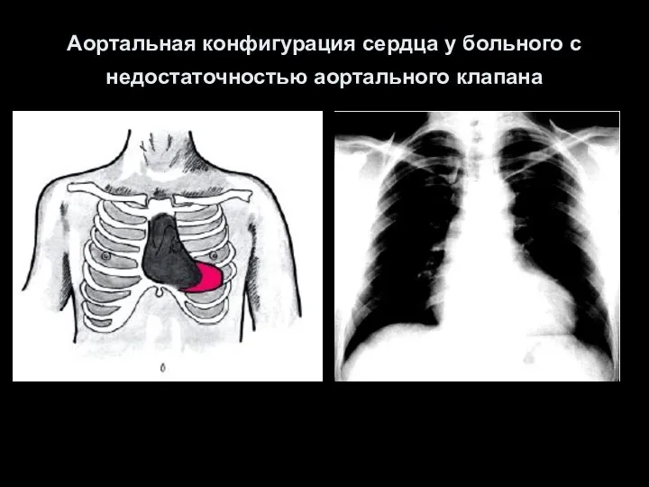 Аортальная конфигурация сердца у больного с недостаточностью аортального клапана